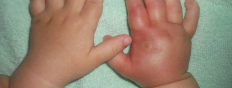 Ребенка укусил комар отекла рука