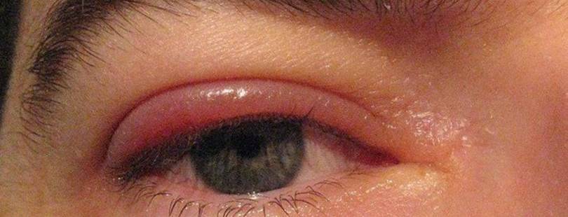Укусил комар в область глаза и опухло веко — что делать?